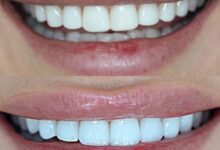 Composite Veneers Brisbane 3