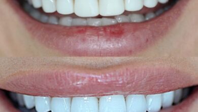 Composite Veneers Brisbane 3