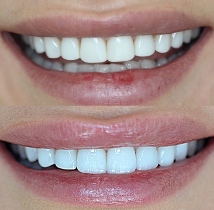Composite Veneers Brisbane 3