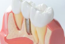 Dental implants
