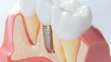 Dental implants